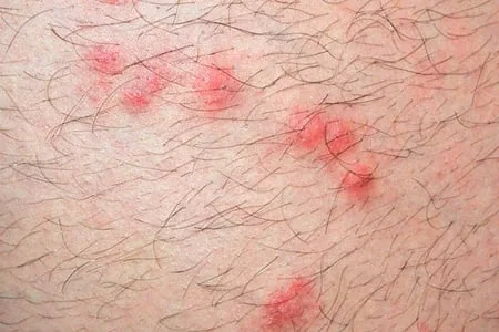 picadura de pulga