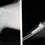 radiografia femur TTA